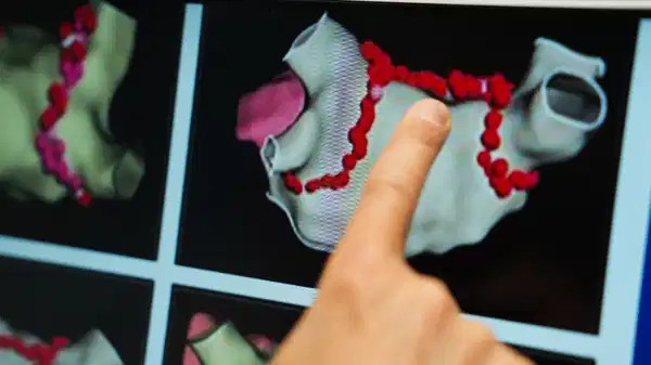 ablasyon tedavisi kalp pili ve sok piline alternatif cozum 4A2BZkjH