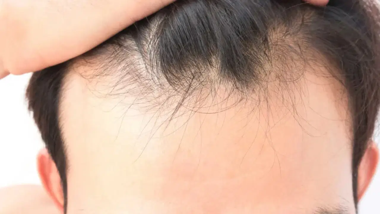 sac dokulmesinde gizli neden vitamin ve mineral eksikligi ne kadar etkili iqaO16Kj.jpg